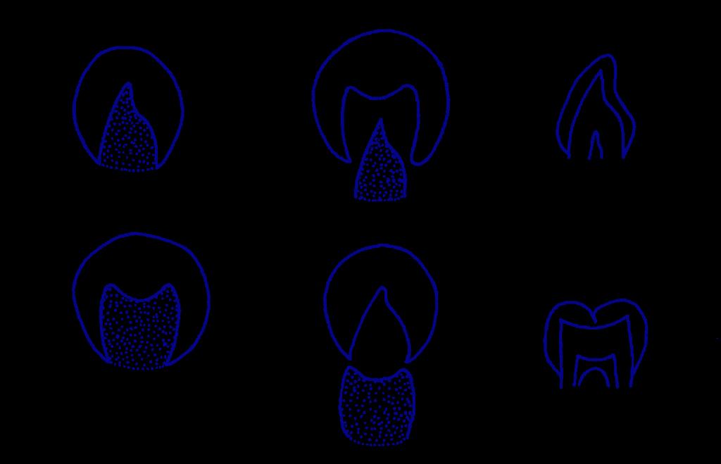 牙乳头 牙乳头在牙发育中的作用 : 决定牙形状