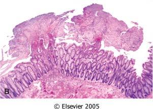 adherent to a reddened colonic mucosa.