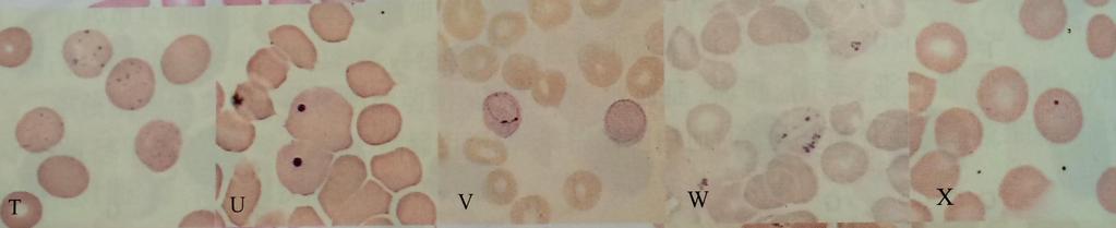 成熟红细胞内含物 形态及分布异常 T 点彩 RBC;U
