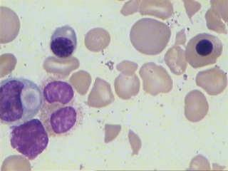 嗜多色性红细胞 ( 溶血性贫血特征 )