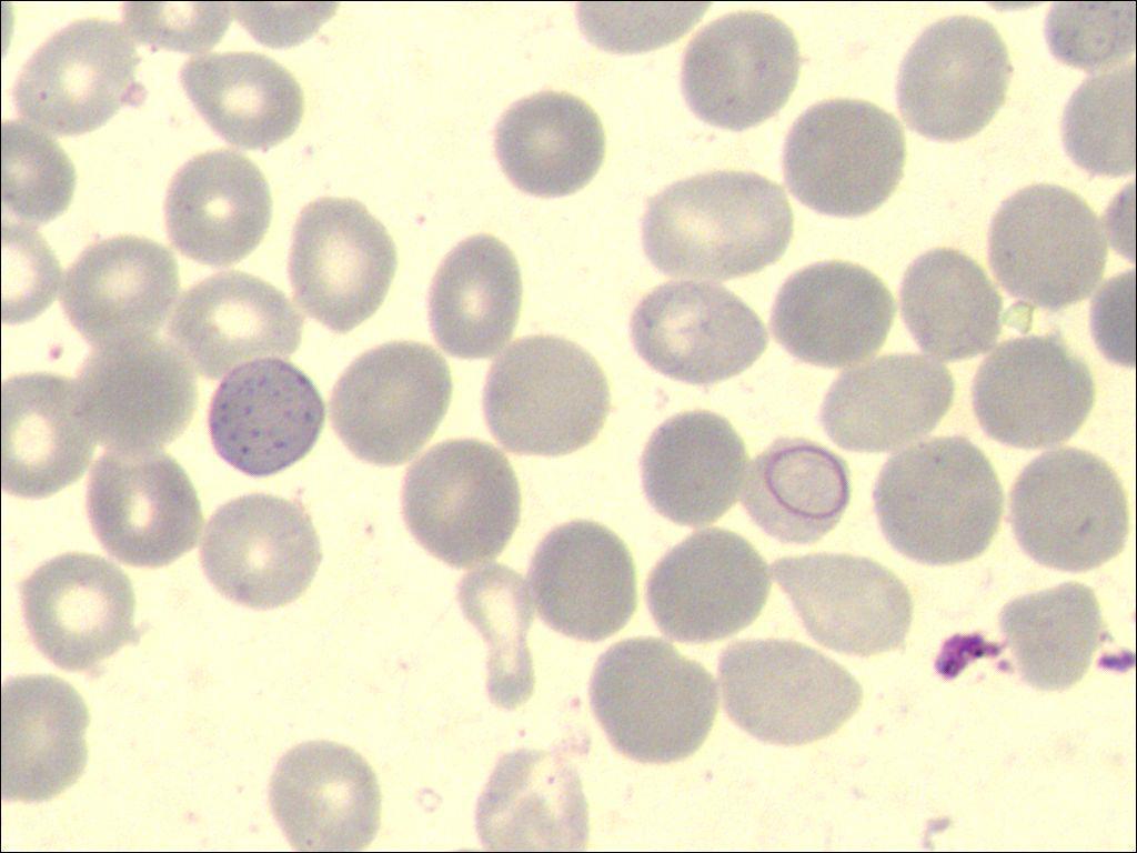 血片 点彩红细胞