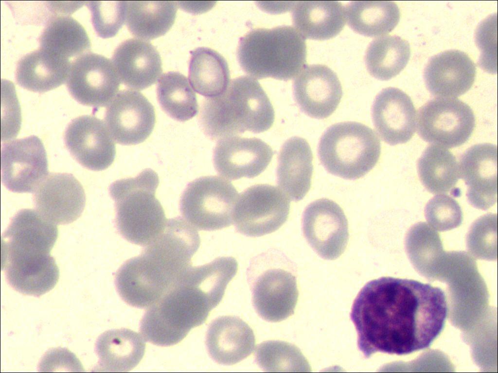 血片 中幼粒细胞