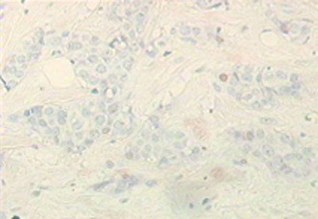 carcinoma patients [n (%)] Pathological pattern c-myc (+)( ) χ 2 /P SIRT1 (+)( ) χ 2 /P Acetyl-p53 (+)( ) χ 2 /P Breast adenosis 8 (26.7%) 22 (73.