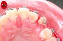 Since the palate is covered by keratinized gingiva, there is little consideration for the impact on soft tissue.