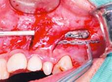 The opposite end of the power chains exited the soft tissue via the distal incision (tunnel opening), and they were attached to a miniscrew