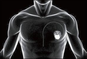 人工心瓣膜植入 永久心脏起搏器 人工关节置换等 哐