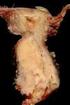 子宫颈癌 （Carcimoma of Cervix uteri）