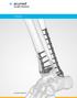 Acumed 是创新骨科和医疗解决方案的全球领导者 我们致力于开发改进患者护理的产品 服务方法和途径 Acumed 锁定踝关节骨板系统 Acumed 锁定踝关节骨板系统在胫骨和腓骨骨折 融合与截骨过程中提供固定 系统设计薄小不显眼, 包括锁定螺钉及对骨板的 II 型阳极化抛光 锁定踝关节骨板系统是下